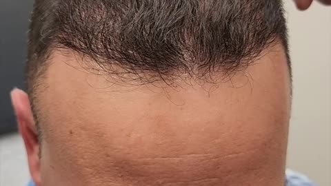 Amazing Before and After Hair Transplant Results!