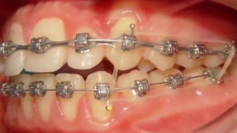 Teeth alignment