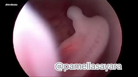 View of 10 weeks fetus in mom's womb