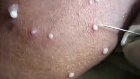 PIMPLE POPPING CYST EXPLOSION BLACKHEAD