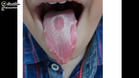 Geographic tongue/Maps on tongue