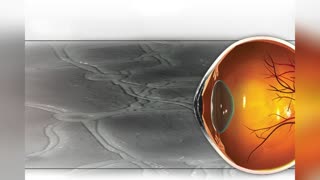 LASIK and Cataract