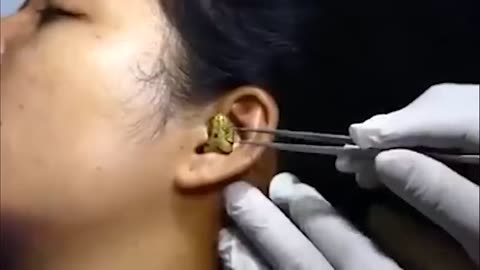 Surgeon’ struggles to remove live snake from woman’s ear
