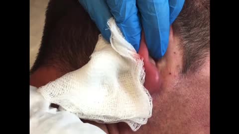 Cyst on Earlobe Drained