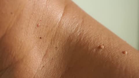 HOW TO REMOVE SKIN TAGS & WARTS~DR.BERG