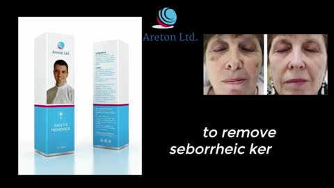 Easy Safe and Effective way to remove Seborrheic Keratosis