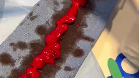 這段視頻是由一名心臟外科醫生為一名 40 歲接種疫苗的運動員拍攝的……查看所有侵入心臟的納米材料石墨烯片，它已引起心肌炎（心臟中的血塊）。