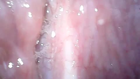 ROGUE INGROWING SCALP HAIRS SCARRING OF MUCOSAL MEMBRANE IN THROAT CONSTRICTING BLOOD FLOW TO BRAIN