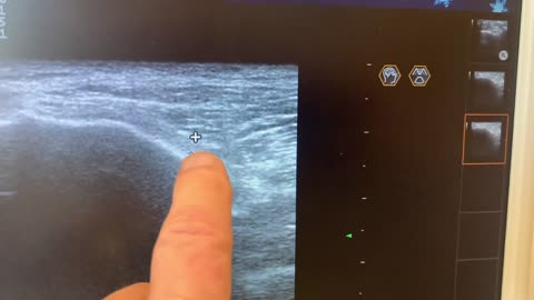 Ultrasound of Compressed Nerve Pre-Surgery - Humberto's Story