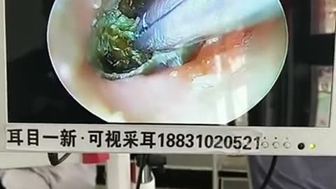 gigantic ear wax removal #44