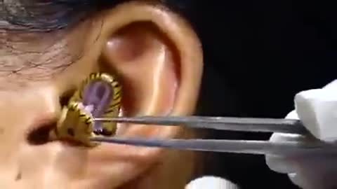 Video: intentan sacarle una serpiente viva del oído