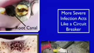 Root Canals (Electric Body Circuits)