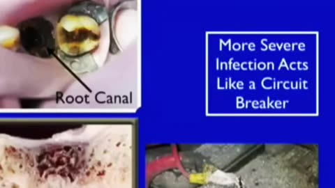 Root Canals (Electric Body Circuits)