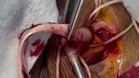 Blood clot extraction-Dr Richard Hirschman-Enbalmer