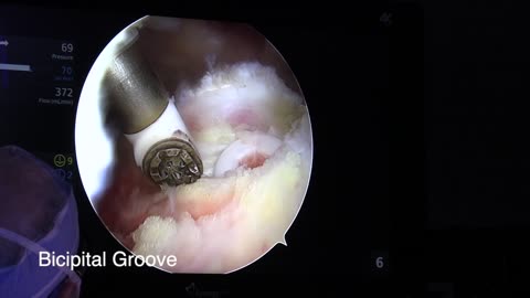 ROTATOR CUFF