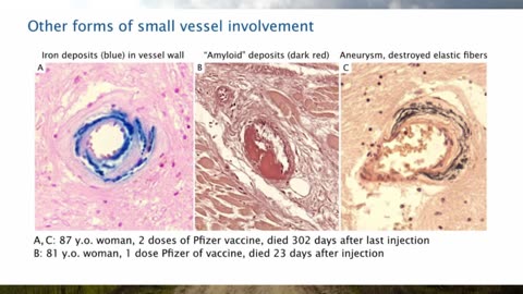 Pathologist Arne Burkhardt Final Interview - Revealing the Grave Dangers of mRNA Vaccines