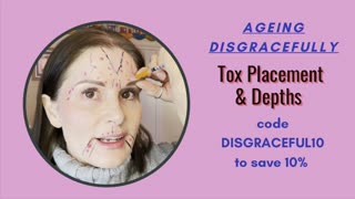 Botox placements & depths