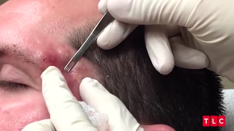 Black head acne removal