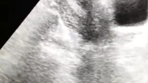 Anatomy of uterus l Uterine Mass l Uterine Fibroid 4