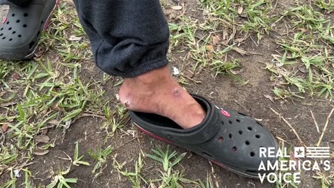 Man from China, shows us the fungus on his feet that he got from the Darien Gap.