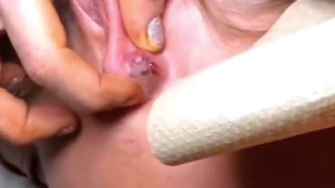 Surprise Explosion of a Cyst Behind Ear