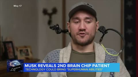 Musk reveals 2nd brain-chip patient