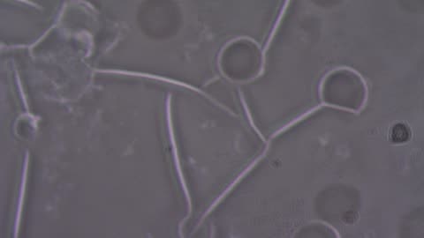 What's Inside The Blood Clots of CV-19 VAXXXed? What is Causing Blood to Clot?