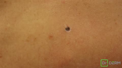 Big blackhead removal