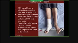 ST5.74 year old diabetic man with right foot pain Punikar