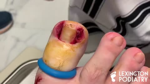 Nail Ingrown Removal WARNING GRAPHIC