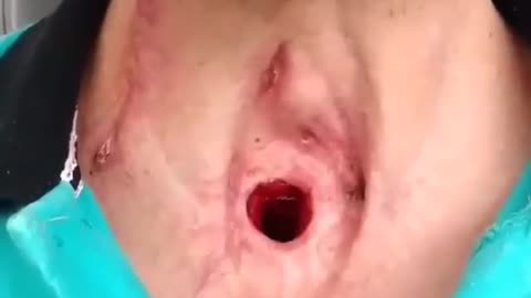 Hole in the Throat!!