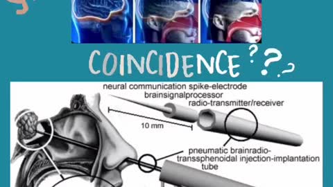 BRAIN RADIO IMPLANT RESEMBLES THE PCR SWAB TEST