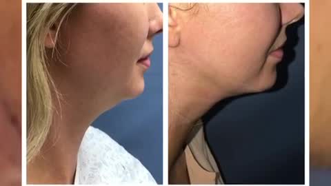 Dr Thomas Barnes AMAZING NECK LIPO RESULTS!