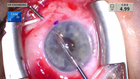 Iridectomy added to double tunnel Ahmed shunt glaucoma surgery