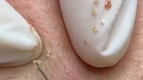 Blackheads Removal & Pimple Popper Cystic Acne Extraction Whiteheads Pimple Popping videos 103