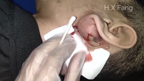 Massive Ear Abscess Incision and Drainage