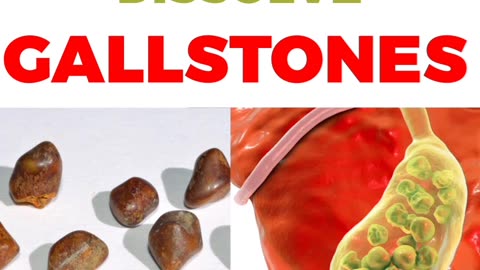 The FASTEST Way To Dissolve Gallstones