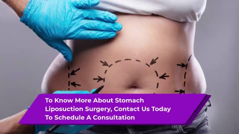Stomach Liposuction Surgery