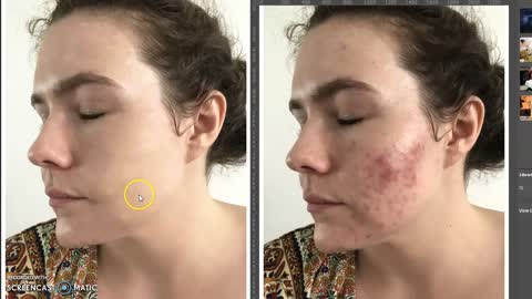 How to remove acne scars from you face with adobe photoshop.