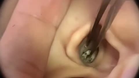 Ear wax removal