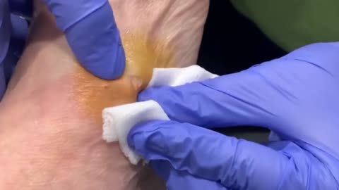 Giants Deep Blackheads, Whiteheads, Big Pimples, Hidden Acne Removal - Best Popping Videos #000028