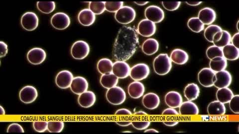 TG NEWS Coaguli di globuli rossi nel sangue dei vaxxinati..