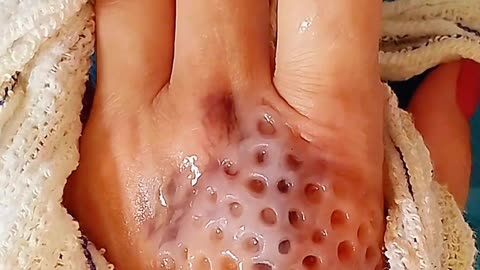 Hand infected Asmr Video
