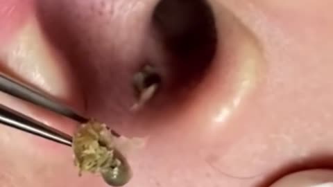 monster blackhead remove in ear