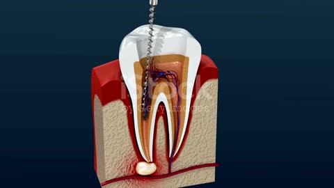 Root Canal Treatment Endodontic