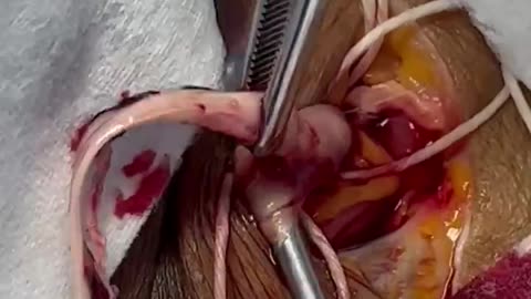 Richard Hirschman removing one of the strange white fibrous clots
