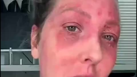 Lady suffers from adverse skin reaction due to injection- 9-2022