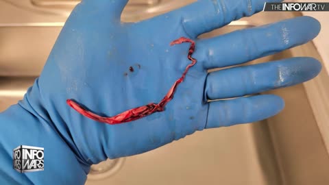 MUST SEE: Mortician Finds Massive Hand-Sized Clots In Cadavers After Vax