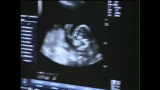 Baby On Ultrasound Gives The Thumbs Up