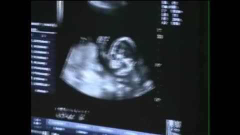 Baby On Ultrasound Gives The Thumbs Up